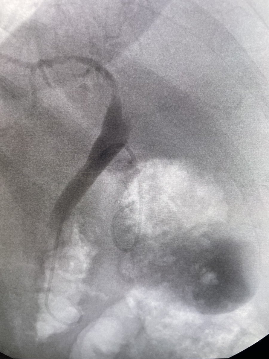 Second of two ERCP gallbladder drains. Nearly identical story, different patient. Cirrhosis, ascites, coagulopathy, gallbladder looks awful on scan. #surgery #ercp #cirrhosis