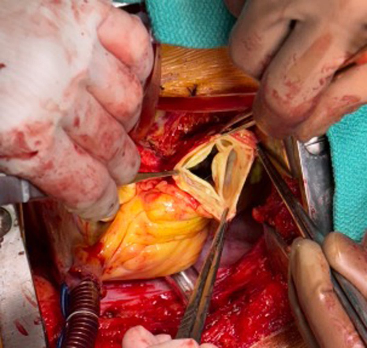 AATS (@aatshq) on Twitter photo Read about the repair of giant pulmonary artery aneurysm and quadricuspid pulmonic valve with valve-sparing pulmonic root replacement in a recent article from researchers at <a href="/stanfordctsurg/">Stanford Cardiothoracic Surgery</a> in #JTCVS Techniques: doi.org/10.1016/j.xjtc… Read about the repair of giant pulmonary artery aneurysm and quadricuspid pulmonic valve with valve-sparing pulmonic root replacement in a recent article from researchers at <a href="/stanfordctsurg/">Stanford Cardiothoracic Surgery</a> in #JTCVS Techniques: doi.org/10.1016/j.xjtc…