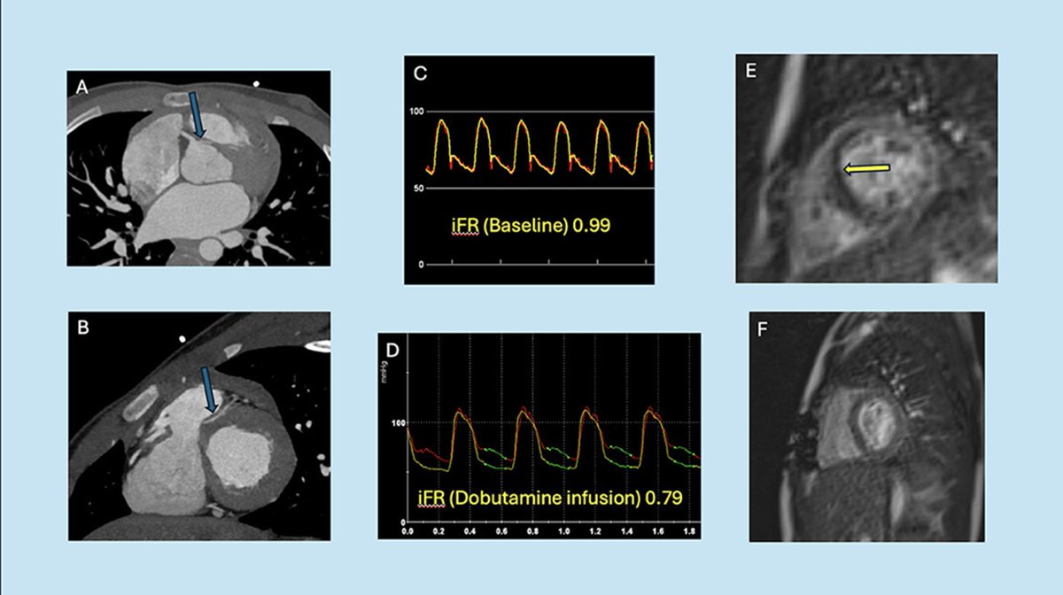 AATS (@aatshq) on Twitter photo .<a href="/silvana_molossi/">Silvana Molossi</a> & <a href="/ShagunSachdeva0/">Shagun Sachdeva</a> recently wrote an Invited Expert Review giving their advice to young athletes who have anomalous #aortic origin of a coronary artery both with and without surgery. Log in to read in Seminars: doi.org/10.1053/j.pcsu… .<a href="/silvana_molossi/">Silvana Molossi</a> & <a href="/ShagunSachdeva0/">Shagun Sachdeva</a> recently wrote an Invited Expert Review giving their advice to young athletes who have anomalous #aortic origin of a coronary artery both with and without surgery. Log in to read in Seminars: doi.org/10.1053/j.pcsu…