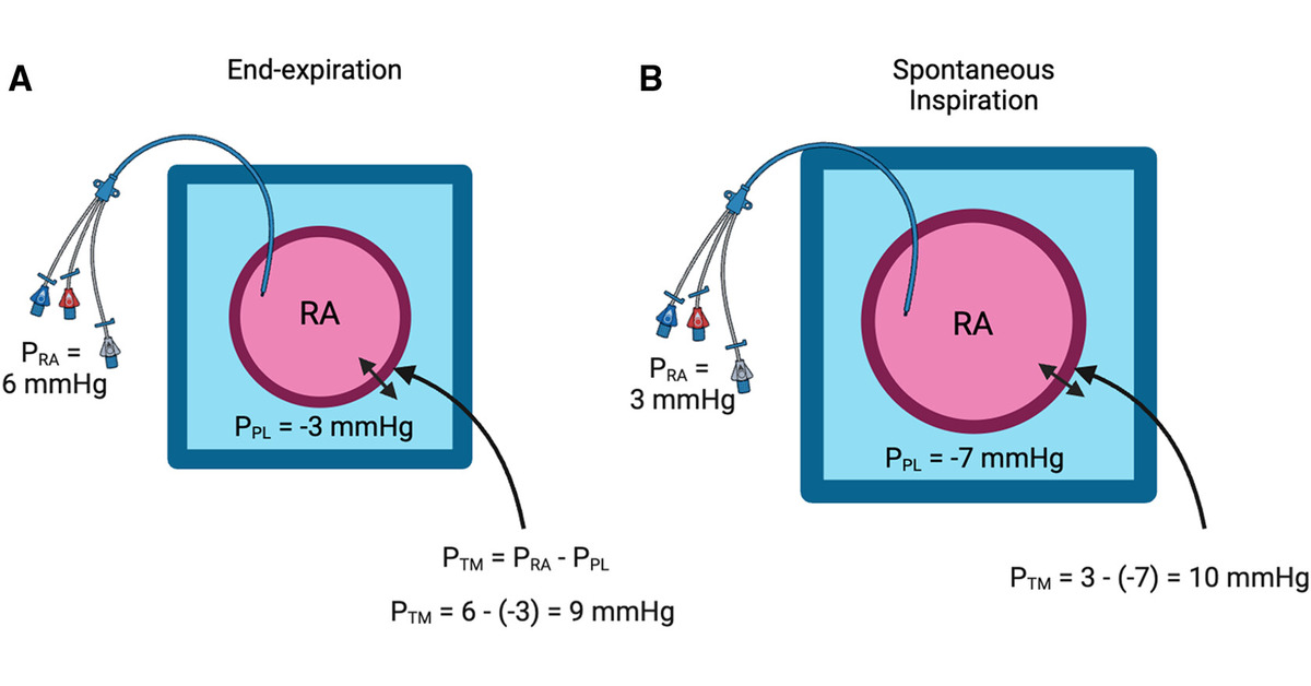 ATS Scholar (@atsscholar) on Twitter photo How I Teach: Heart–Lung Interactions during Mechanical Ventilation. Positive Pressure and the Right Ventricle
How we teach the impact of positive pressure ventilation on right heart filling and emptying
<a href="/CardsNYC/">Eugene Yuriditsky</a> <a href="/carlosalviar/">Carlos L. Alviar MD, FACC</a> <a href="/emireles_c/">Eduardo Mireles-Cabodevila</a>
🔗 tinyurl.com/bdzhdcmk How I Teach: Heart–Lung Interactions during Mechanical Ventilation. Positive Pressure and the Right Ventricle
How we teach the impact of positive pressure ventilation on right heart filling and emptying
<a href="/CardsNYC/">Eugene Yuriditsky</a> <a href="/carlosalviar/">Carlos L. Alviar MD, FACC</a> <a href="/emireles_c/">Eduardo Mireles-Cabodevila</a>
đź”— tinyurl.com/bdzhdcmk