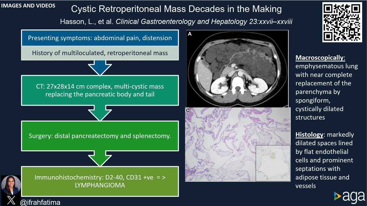Joseph Sleiman, MD, FACP (@josephhabibi_md) on Twitter photo #CGH4ALL📣 💥#GITwitter
An incidental retroperitoneal mass case with a twist!
Read now by @HassonLenaet al <a href="/AGA_CGH/">CGH</a>🔥!
🔗 doi.org/10.1016/j.cgh.…
Reported by <a href="/ifrahfatima/">Ifrah Fatima</a>
<a href="/drkeithsiau/">Keith Siau</a>
<a href="/stevenbollipo/">Steven Bollipo</a>
<a href="/GI_Pearls/">GI Pearls</a>
<a href="/MN_GIMD/">Mariam Naveed, MD</a>
<a href="/AimenKhanMD/">Aimen Farooq</a>
<a href="/SanjeevaniTomar/">Sanjeevani Tomar, MD</a>
<a href="/Meghs1119/">Meghana Vellanki, M.D.</a>
<a href="/doctornikkid/">Nikki Duong, M.D.</a> #CGH4ALL📣 💥#GITwitter
An incidental retroperitoneal mass case with a twist!
Read now by @HassonLenaet al <a href="/AGA_CGH/">CGH</a>🔥!
🔗 doi.org/10.1016/j.cgh.…
Reported by <a href="/ifrahfatima/">Ifrah Fatima</a>
<a href="/drkeithsiau/">Keith Siau</a>
<a href="/stevenbollipo/">Steven Bollipo</a>
<a href="/GI_Pearls/">GI Pearls</a>
<a href="/MN_GIMD/">Mariam Naveed, MD</a>
<a href="/AimenKhanMD/">Aimen Farooq</a>
<a href="/SanjeevaniTomar/">Sanjeevani Tomar, MD</a>
<a href="/Meghs1119/">Meghana Vellanki, M.D.</a>
<a href="/doctornikkid/">Nikki Duong, M.D.</a>