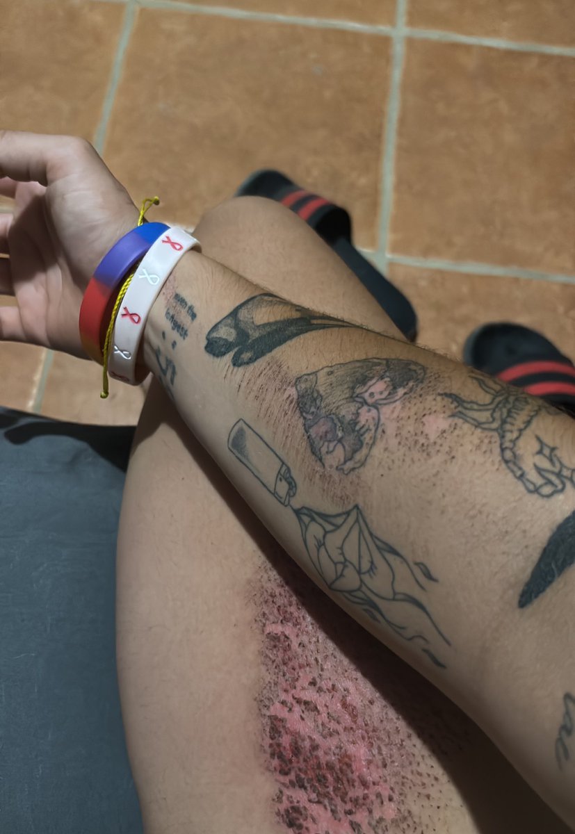 Un accidente, creo que trauma para todos jaja. Choqué contra un perro, creo falleció y yo casi me voy para el cielo por haber puesto primero la ceja antes que las manos, jaja es que si me fui de jupa contra el pavimento, gracias a Dios no fue más!
USEN CASCO Y NO MANEJEN RÁPIDO.
