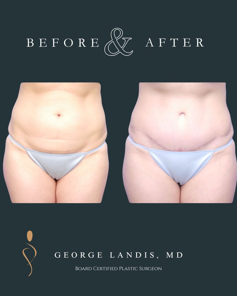 LandisPlastic's tweet photo. A tummy tuck, or abdominoplasty, is a surgery that removes extra skin and fat from the belly and tightens the stomach muscles. For a middle-aged woman, this procedure can make a big difference in several ways.
First, it can improve how she feels about her body. Many women, especially after pregnancy or weight changes, have loose skin or a belly that won’t go away no matter how much they exercise. This can make them feel self-conscious or uncomfortable in their clothes. A tummy tuck can create a flatter, smoother stomach, which often boosts confidence and makes it easier to wear things like swimsuits or fitted dresses.
Second, it can help with physical comfort. Extra skin or weak stomach muscles can cause back pain or make it harder to stay active. By tightening the muscles and removing excess skin, a tummy tuck can make daily activities like walking, exercising, or even standing for long periods feel easier and less painful.
Third, it can be a mental and emotional lift. Feeling good about your appearance can improve your mood and outlook. For some women, a tummy tuck is a way to reclaim their body after years of focusing on family or work, helping them feel more like themselves again.
It’s not a quick fix, though—recovery takes time, and there are risks, like with any surgery. But for many women, the changes to their body and confidence can feel life-changing, making them happier and more comfortable in their own skin.