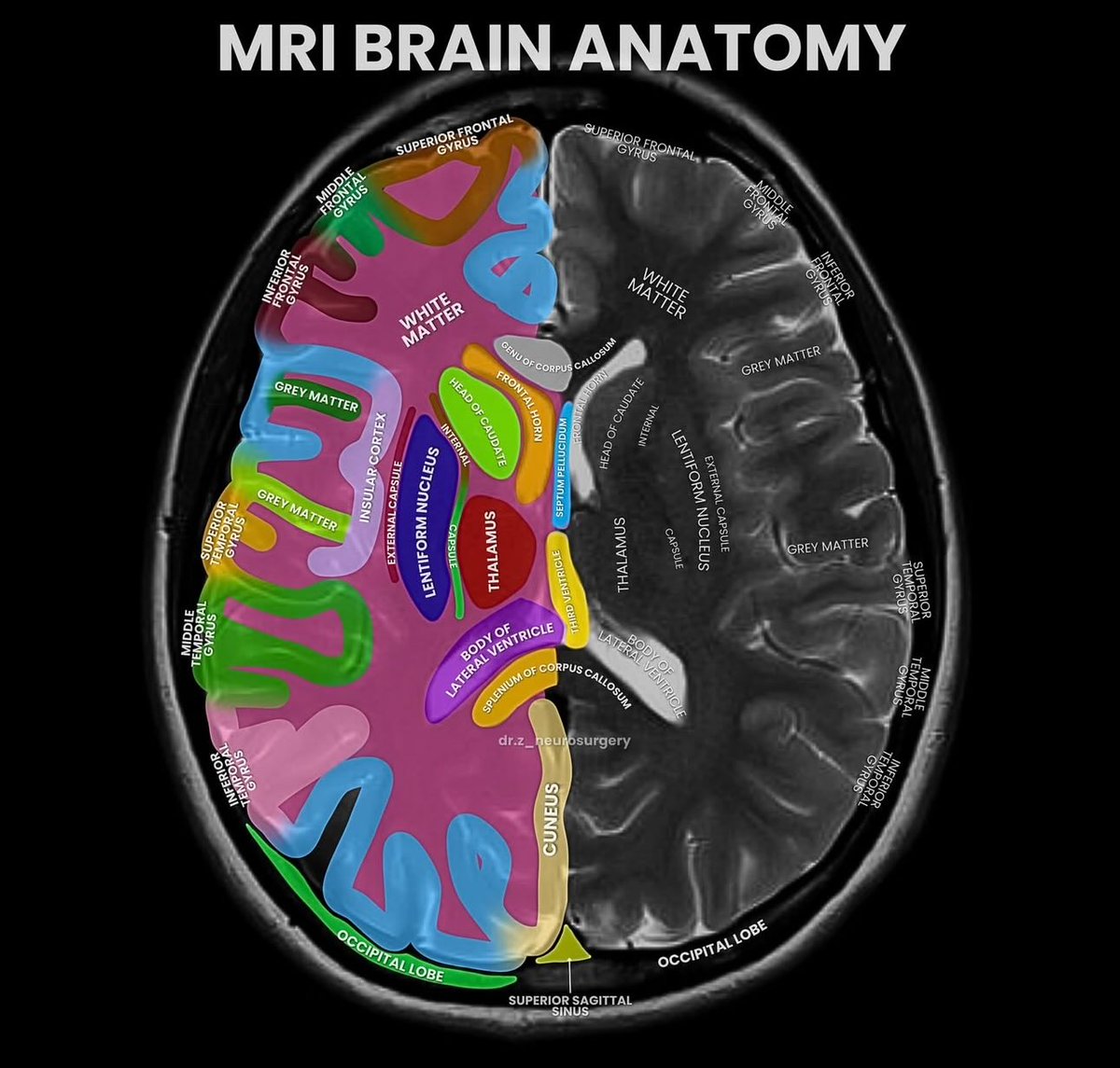 OGdukeneurosurg's tweet photo. MRI brain anatomy by @DrZNeurosurgery https://t.co/GouFG7M3sm