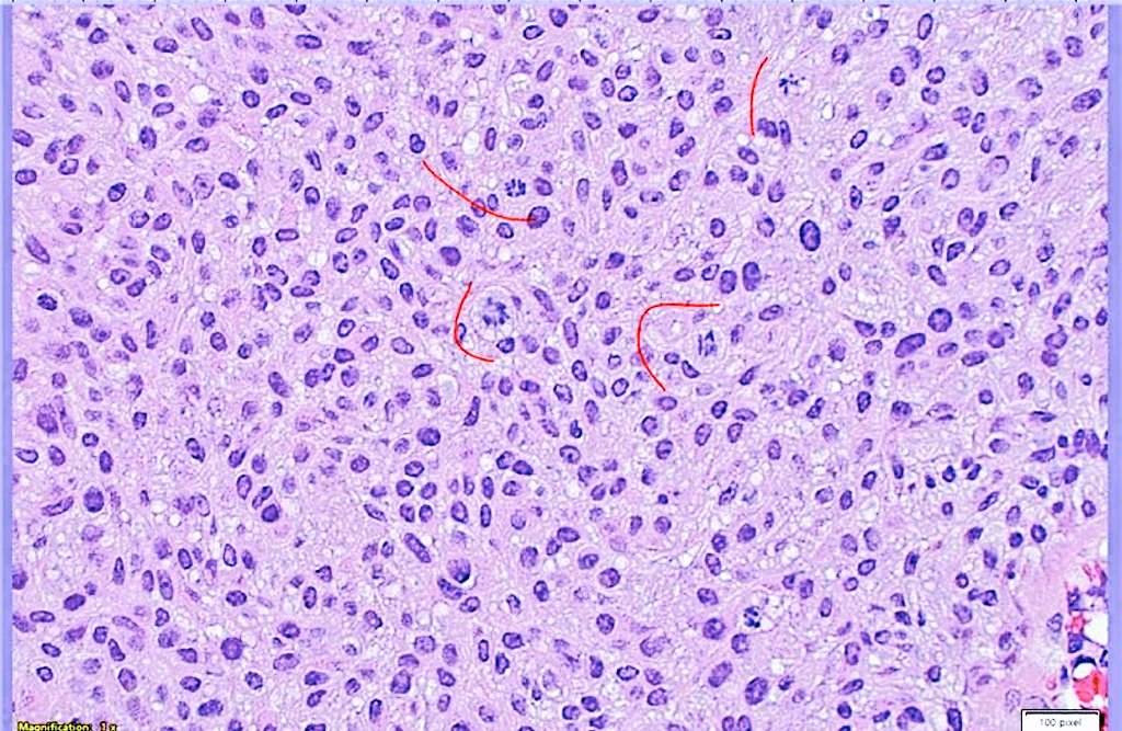 TURBT, transurethral resection of bladder tumor. You can still see mitoses in low-grade, but should not see them in the upper half or at the surface of low-grade urothelial carcinoma.
#gupathology #PathTwitter #pathX