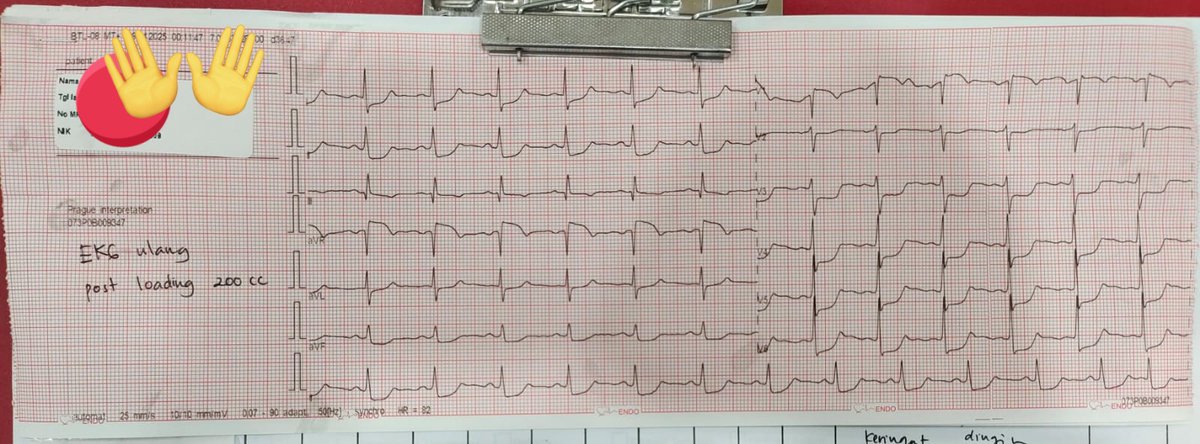 FerrisagaJP's tweet photo. P1A, Ny. SA, dewasa muda, berdebar dan nyeri dada. Hemodinamik jelek. Namun klinis pasien msh baik.
Fluid challenge dikit buat ngetes  syoknya sambil pijat karotis...
Boom💥
Memang Allah selalu memberi hambanya jalan 🥲😭
Convert sinus✨ walau NSTEMI very high risk di depan mata https://t.co/UIhRjYL7ZP