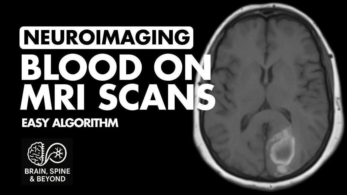 BrainSpineByond's tweet photo. Interpreting blood on MRI imaging can be tricky

In this video, we simplify this assessment using a very easy to remember analogy

Watch the video through this link
https://t.co/DXNq07DQ5a 

#Neurosurgery #Spine #PassNeurosurgery #MedTech https://t.co/4ABOlsf87F