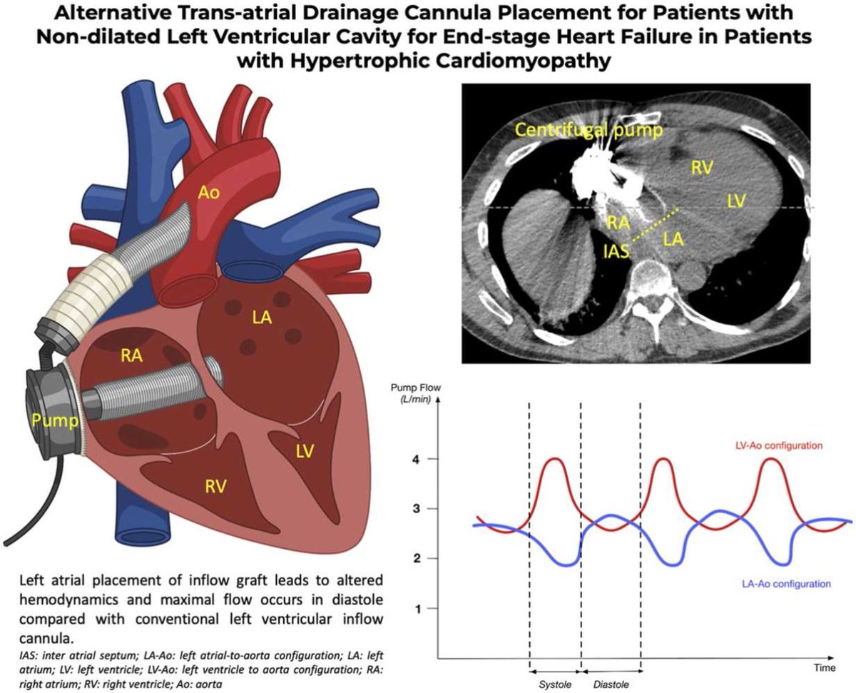 Darshan H Brahmbhatt (@doctor_darshan) on Twitter photo Very excited to see our latest manuscript published in <a href="/TheJHLT/">JHLT</a> Open - Alternative cannulation technique for #LVAD therapy in patients with Hypertrophic Cardiomyopathy with #PierreEmmanuelNoly, Viv Rao, Nicole Fung, <a href="/FilioBillia/">Filio Billia</a> & <a href="/BadiwalaMD/">Mitesh Badiwala MD PhD</a>
jhltopen.org/article/S2950-… Very excited to see our latest manuscript published in <a href="/TheJHLT/">JHLT</a> Open - Alternative cannulation technique for #LVAD therapy in patients with Hypertrophic Cardiomyopathy with #PierreEmmanuelNoly, Viv Rao, Nicole Fung, <a href="/FilioBillia/">Filio Billia</a> & <a href="/BadiwalaMD/">Mitesh Badiwala MD PhD</a>
jhltopen.org/article/S2950-…