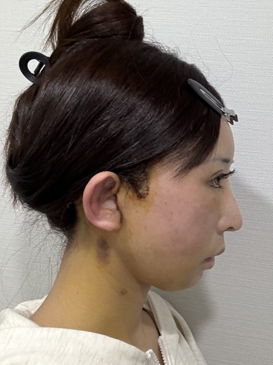 an20230422's tweet photo. 【術後7日目】
今日は一部抜糸してもら��ました♪

昨日の検診では念願のシャンプーをしていただき✨️本当にありがたいアフターケアです♪♪優しく洗っていただき気持ち良かったです(⁎⁍̴̛ᴗ⁍̴̛⁎)

残りは日本で抜糸します！

#セミン整形外科 #整形垢 #韓国整形 
#切開リフト #フェイスリフト https://t.co/jvBp62VnHV