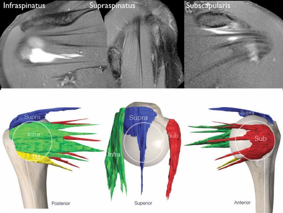 Rotator cuff muscles/tendons

☑️supraspinatus👉🏼a single tendon within a bipennate muscle
☑️subscapularis👉🏼four tendons that span the insertion
☑️infraspinatus👉🏼an oblique head (effective head depressor) &amp; a transverse head (effective external rotator)

jisakos.com/article/S2059-…