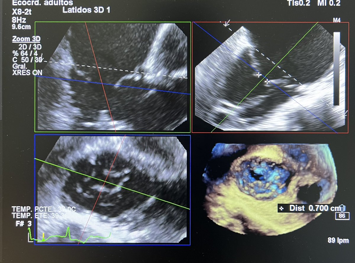 josecaferca's tweet image. Planning T-TEER for this atrial torrential TR. How will you manage it? It looks like type I TV with little septal indentation