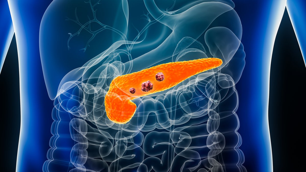 CSIC (@csic) on Twitter photo 🧑🔬Identifican un nuevo factor que determina la agresividad del cáncer de páncreas
👩🔬Equipos del <a href="/iibbcsic/">IIBB - CSIC</a> y el <a href="/HMar_research/">HMar Research Institute</a> demuestran el papel clave de una proteína en el núcleo de las células que rodean el tumor
👉 tiny.cc/rllg001 🧑🔬Identifican un nuevo factor que determina la agresividad del cáncer de páncreas
👩🔬Equipos del <a href="/iibbcsic/">IIBB - CSIC</a> y el <a href="/HMar_research/">HMar Research Institute</a> demuestran el papel clave de una proteína en el núcleo de las células que rodean el tumor
👉 tiny.cc/rllg001
