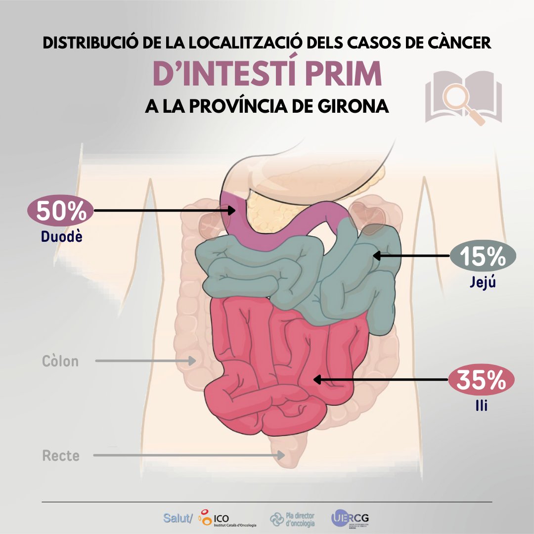 rc_Girona's tweet photo. El càncer situat a l'intestí prim és poc freqüent, aproximadament 7 casos anuals a la província de Girona, però la meitat apareixen al duodè. https://t.co/PnMQKWgh7Q