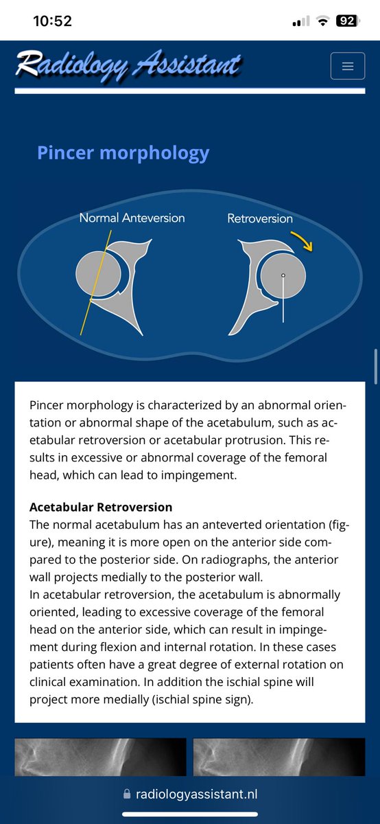 Adam Weir (@adamweirsports) on Twitter photo Interested in FAIS
Cam and pincer
What do we look at on imaging
Check out new free resource on
Radiology Assistant
<a href="/loes/">Marloes van der Heijden</a> made some nice figures!
See link
radiologyassistant.nl/musculoskeleta…
Please share Interested in FAIS
Cam and pincer
What do we look at on imaging
Check out new free resource on
Radiology Assistant
<a href="/loes/">Marloes van der Heijden</a> made some nice figures!
See link
radiologyassistant.nl/musculoskeleta…
Please share
