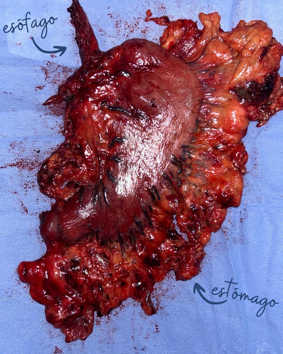 Cirugía Oncológica Mínimamente Invasiva.
👨🏻de 39 años con CA de unión Gastro-Esofágica. Una localización desafiante que exige la resección tanto del esófago distal como del estómago, así como del vaciamiento ganglionar en abdomen y mediastino. Paciente recuperado y en seguimiento