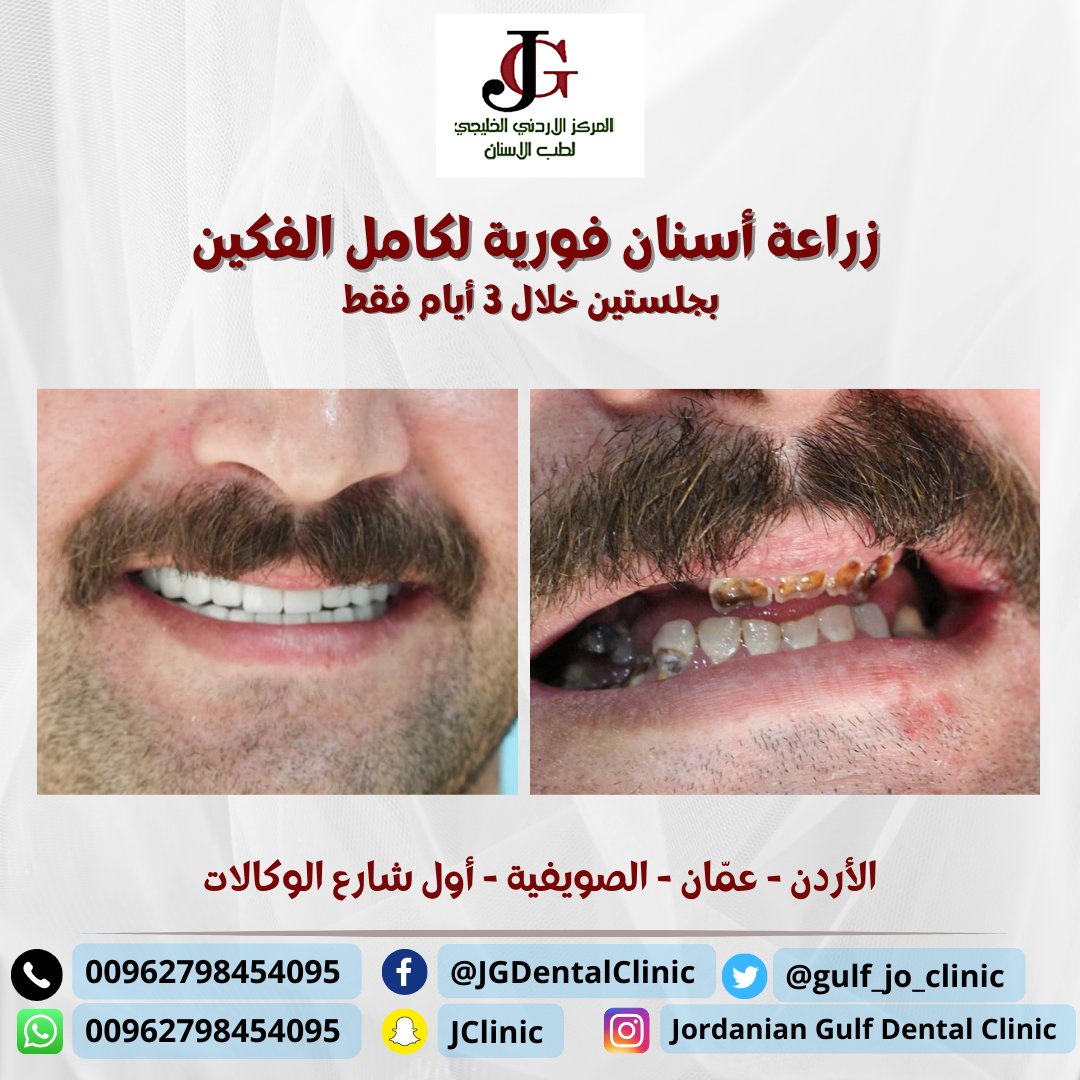 gulf_jo_clinic's tweet photo. المركز الأردني الخليجي لطب الأسنان مختص بالزراعة الفورية وتجميل الأسنان.. مع وجود كادر طبي يتمتع بخبرة طويلة وكفاءة طبية متميزة باحترافية عالية لضمان الحصول على أفضل النتائج الممكنة ان شاء الله.

يقدم المركز الخدمات التالية :
🦷 زراعة الأسنان الفورية والعادية.
✨ التلبيسات السنية (الزيركون والبورسلان).
🦷 القشور الخزفية (emax) /الفينير ، ابتسامة هوليود /.
✨ جراحة وتجميل اللثة والفكين.
🦷 تقويم الأسنان بجميع أنواعه.
✨ نزع العصب والحشوات التجميلية والعادية.
🦷 قسم خاص لعلاج جميع مشاكل الأسنان لدى الأطفال.
 وغيرها..
/
📍عنوان المركز : عمّان - الصويفية - أول شارع الوكالات - مقابل لبناني سناك - مجمع الواحة ط1.
/
📞 للتواصل المباشر مع الأطباء المختصين في المركز :
د. يزن 0798454095
واتس (رابط مباشر) https://t.co/rc6TFtBNol
د. محمد 0776525354
واتس https://t.co/sAv6LYXy5M
/

نتشرف باستقبالكم وعلاجكم ونسعد بتقديم خدمة مميزة تليق بكم وبسمعتنا عندكم 🌹.

#مادبا #madaba #زراعة_الأسنان #الزراعة_الفورية #تجميل_الأسنان #القشور_الخزفية #فينير #السعودية #البحرين #الكويت #الكوليسترول #عمان #قطر #العراق #السكري #الأردن #زراعة_الأسنان_الفورية #زيركون #تلبيسات_زيركون #تلبيسات_الزيركون #بورسلان #الفينير #ابتسامة_هوليود #ابتسامة_المشاهير #EMAX