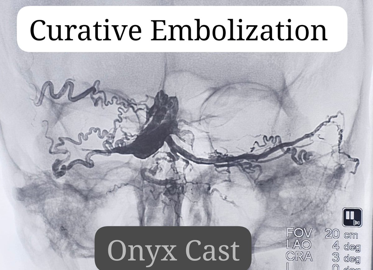 SharathKumarGG7's tweet photo. Post CVT - Torcular DAVF presenting with progressive visual deterioration. Curative Embolization was achieved through tiny MMA feeder. One of the most effective & elegant procedure in Interventional Neuroradiology for such complex malformation. #Embolization #DAVF #Neurointervention