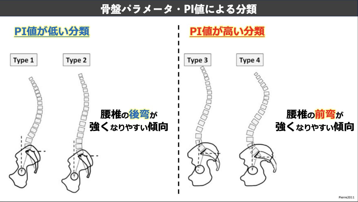✓骨盤パラメーター・PI値による分類 ☑️PI値が【高い】【低い】場合の傾向 PI値が低い場合 ：腰椎の後弯が強くなりやすい PI値が高い場合  ：腰椎の前弯が強くなりやすい という特徴があります この観点でも患者様を見ていますが色々気づくことが、、！！！ セミナーURL ...