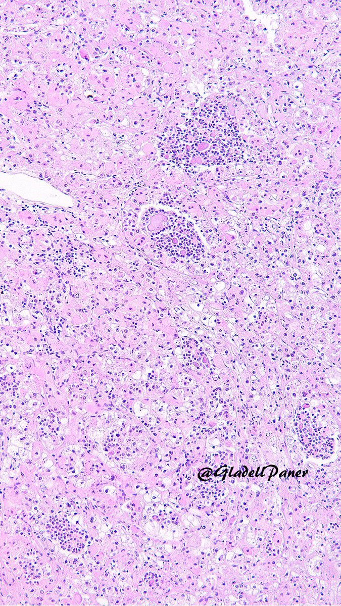 What is your top morphologic diagnosis for this renal mass with unique histology? #GUPath #OnePicDx 🔬

Answer in comment 👇🏻👇🏻👇🏻