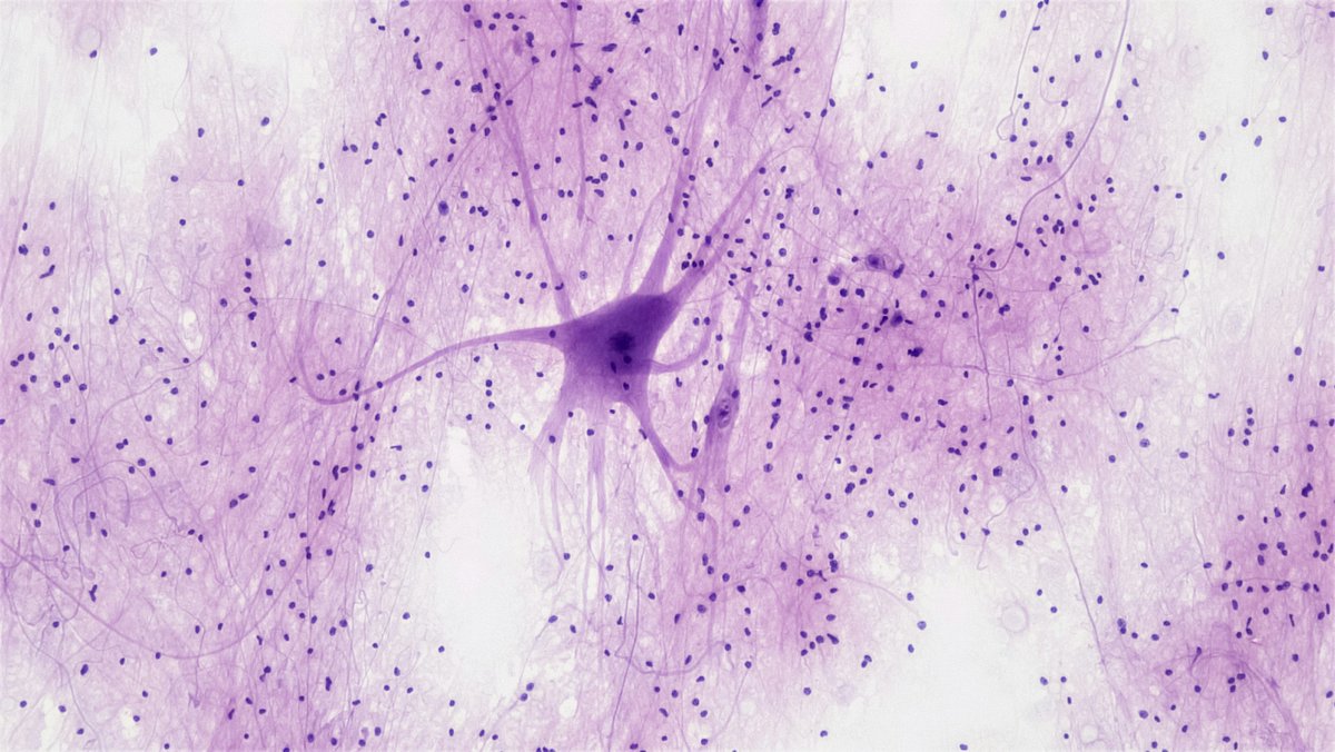 The Vilcek Foundation (@vilcek) on Twitter photo Listen to this <a href="/NPR/">NPR</a> interview! <a href="/Sergiu_P_Pasca/">Sergiu P. Pasca</a>, researcher of neurosceince at <a href="/Stanford/">Stanford University</a>, worked with a team to recreate a model of the human pain pathway.
Winner of our Vilcek Prize for Creative Promise in Biomedical Science in 2018, Pasca and his team exposed the system to the Listen to this <a href="/NPR/">NPR</a> interview! <a href="/Sergiu_P_Pasca/">Sergiu P. Pasca</a>, researcher of neurosceince at <a href="/Stanford/">Stanford University</a>, worked with a team to recreate a model of the human pain pathway.
Winner of our Vilcek Prize for Creative Promise in Biomedical Science in 2018, Pasca and his team exposed the system to the