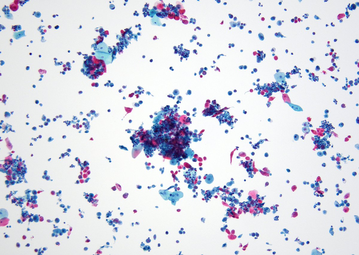 Primary (pure) "Squamous Cell Carcinoma" of the bladder is quite uncommon in our Cyto practice at Hopkins (like the case seen here on voided urine). Most cases that we see end up being "High-grade Urothelial CAs with focal squamous cell features". (ThinPrep)