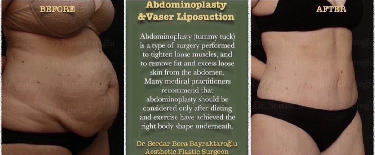 Clinicsbbintl's tweet photo. ABDOMINOPLASTY / VASER LIPOSUCTION

You can get rid of your sagging areas with intense weight gain and loss with abdominoplasty and vaser liposuction surgery .

#vaserliposuction #abdominoplasty #clinicsbbinternational #aestheticsurgery #aesthetic #plasticsurgeon #plasticsurgery https://t.co/gGmNkzReKm