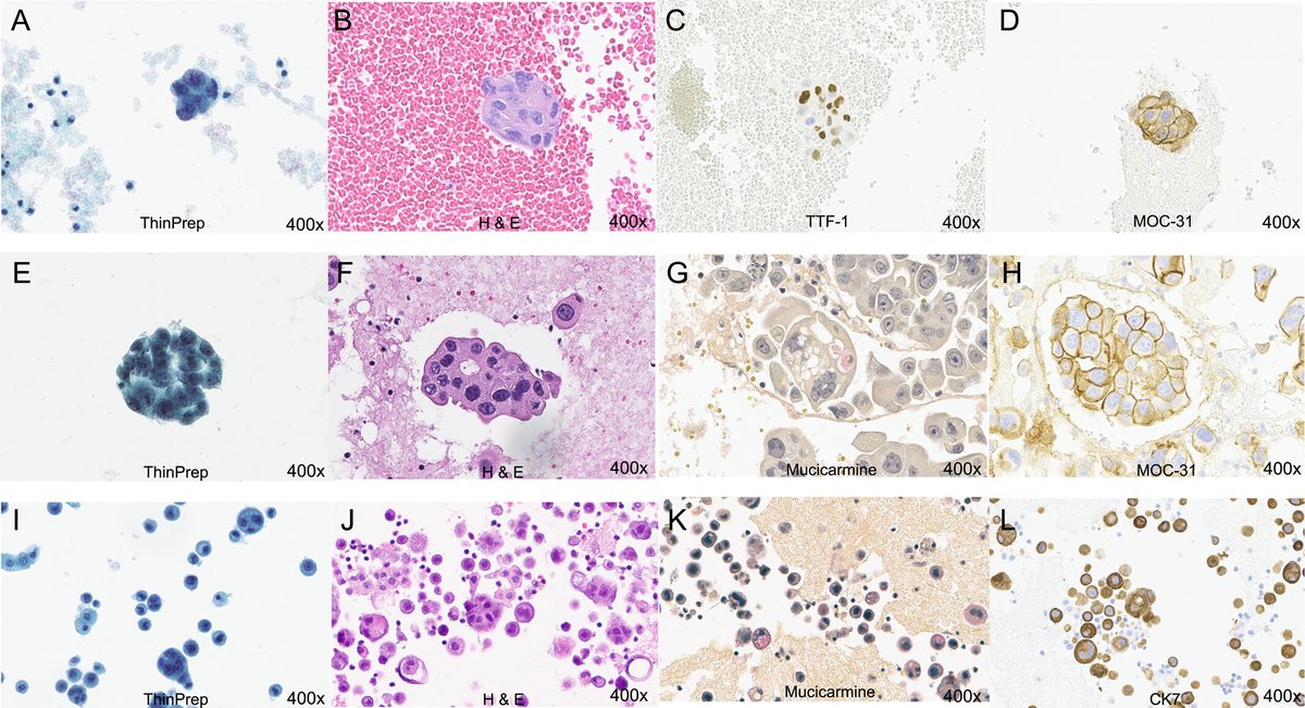 Cancer Cytopathology (@cancercytopath) on Twitter photo ✨ New this week! Clinicopathological and molecular characterization of non–small cell lung cancer with pericardial effusions
acsjournals.onlinelibrary.wiley.com/doi/full/10.10…
#CytoPath <a href="/markma666666/">Weijie (Mark) Ma</a> <a href="/darcykerrMD/">Darcy A. Kerr</a> <a href="/LJTafeMD/">Laura J. Tafe, MD</a> <a href="/nathrodriguesMD/">Nathalie Rodrigues Simoes, MD</a> ✨ New this week! Clinicopathological and molecular characterization of non–small cell lung cancer with pericardial effusions
acsjournals.onlinelibrary.wiley.com/doi/full/10.10…
#CytoPath <a href="/markma666666/">Weijie (Mark) Ma</a> <a href="/darcykerrMD/">Darcy A. Kerr</a> <a href="/LJTafeMD/">Laura J. Tafe, MD</a> <a href="/nathrodriguesMD/">Nathalie Rodrigues Simoes, MD</a>
