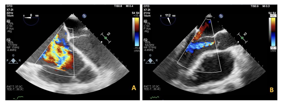 Circ: Heart Failure (@circhf) on Twitter photo Long-standing, asymptomatic ventricular fibrillation under LVAD support leading to disseminated intracardiac thrombosis <a href="/papathanasiou_/">Maria Papathanasiou</a> @Morshuis #AHAJournals ahajrnls.org/4jeSy0v Long-standing, asymptomatic ventricular fibrillation under LVAD support leading to disseminated intracardiac thrombosis <a href="/papathanasiou_/">Maria Papathanasiou</a> @Morshuis #AHAJournals ahajrnls.org/4jeSy0v