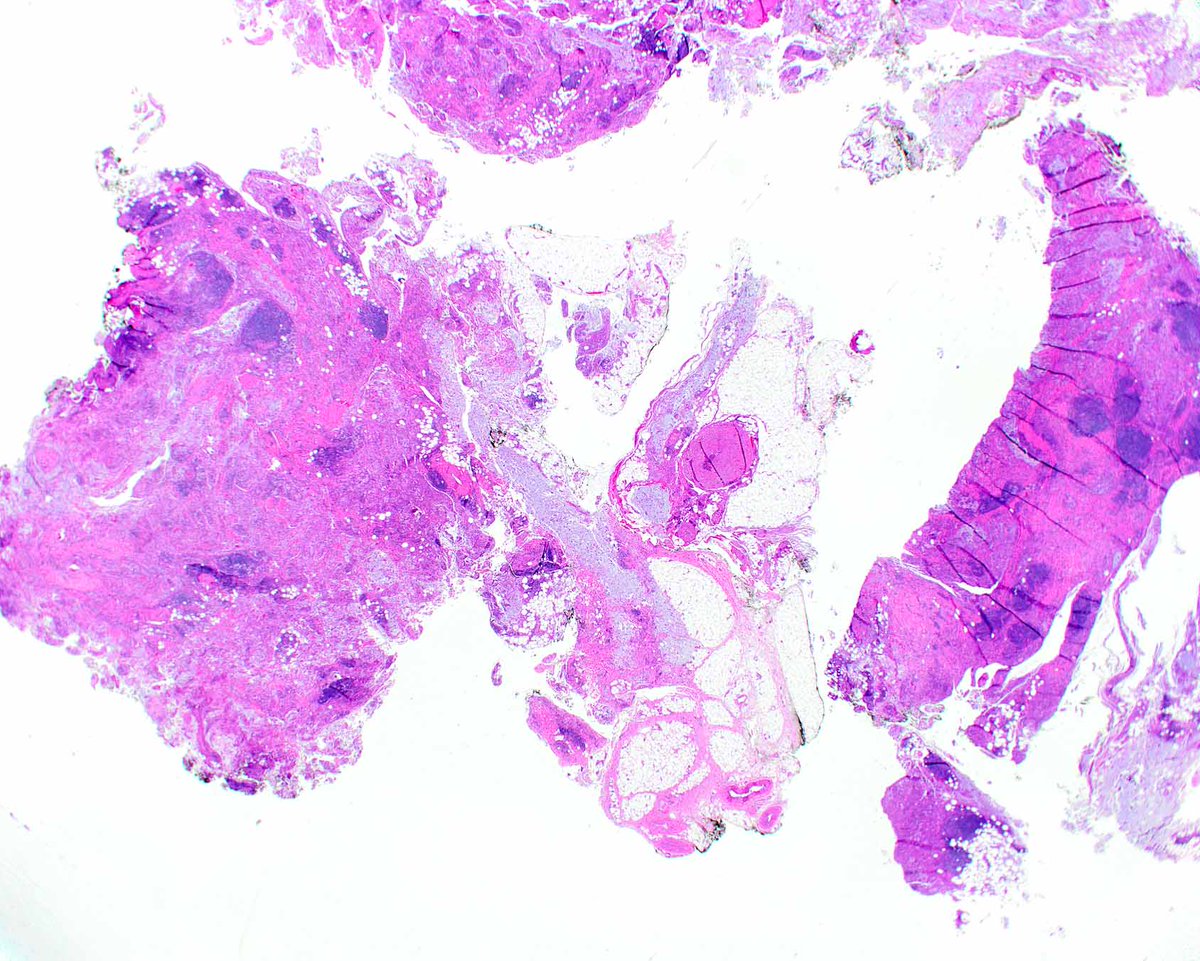ModernPathology's tweet image. Myxoinflammatory fibroblastic sarcoma was first described in Modern Pathology using different terminology. It&apos;s one of the many legacies of Dr. Sharon Weiss, a grande dame of pathology. 
Montgomery EA, Devaney KO, Giordano TJ, Weiss SW. Inflammatory myxohyaline tumor of distal…