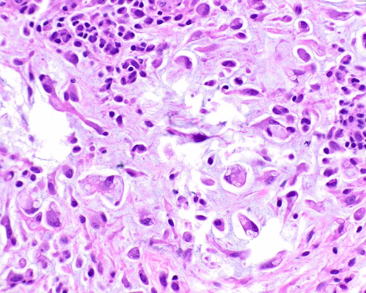 ModernPathology's tweet image. Myxoinflammatory fibroblastic sarcoma was first described in Modern Pathology using different terminology. It&apos;s one of the many legacies of Dr. Sharon Weiss, a grande dame of pathology. 
Montgomery EA, Devaney KO, Giordano TJ, Weiss SW. Inflammatory myxohyaline tumor of distal…