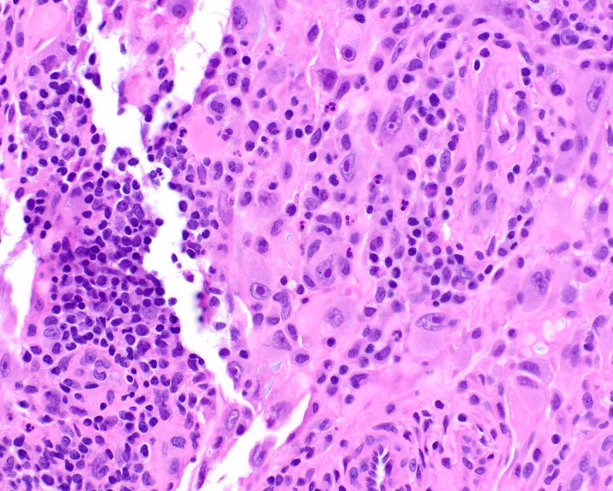 ModernPathology's tweet image. Myxoinflammatory fibroblastic sarcoma was first described in Modern Pathology using different terminology. It&apos;s one of the many legacies of Dr. Sharon Weiss, a grande dame of pathology. 
Montgomery EA, Devaney KO, Giordano TJ, Weiss SW. Inflammatory myxohyaline tumor of distal…