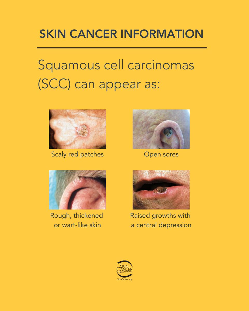 Squamous cell carcinoma is the second most common form of skin cancer—and it can become dangerous if left untreated.
skincancer.org/skin-cancer-in…