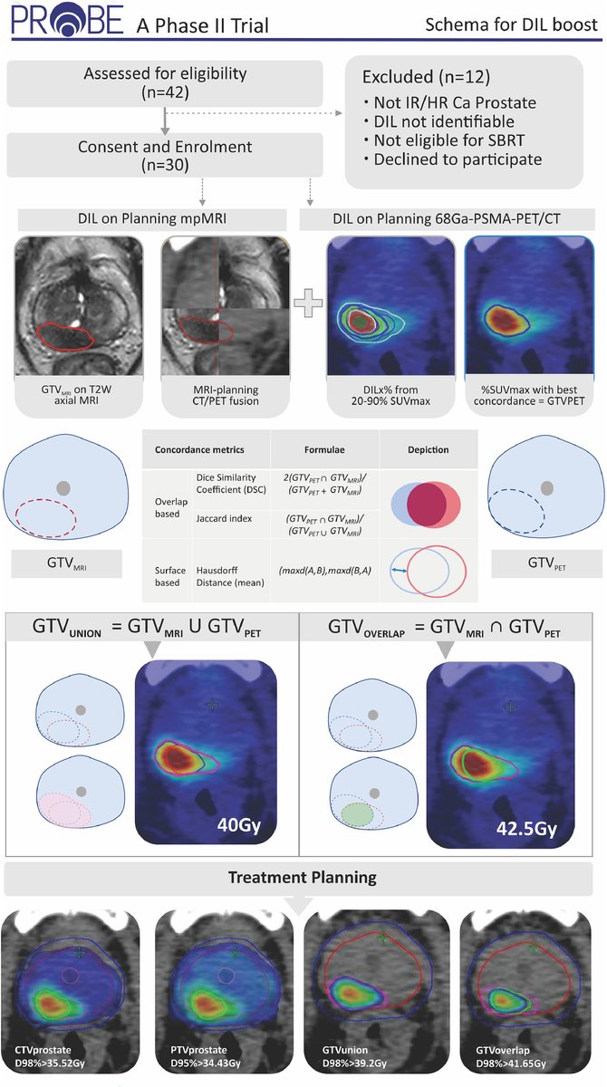 ASTRO (@astro_org) on Twitter photo From @vedangmurthy @priyamvadamaitre <a href="/drmaneesh_singh/">Maneesh Singh</a> et al: SABR clinical trials special issue; PROBE the DIL. Feasibility and safety report of PSMA-PET based focal boost in prostate SBRT. #RedJournal: tinyurl.com/redmurthy From @vedangmurthy @priyamvadamaitre <a href="/drmaneesh_singh/">Maneesh Singh</a> et al: SABR clinical trials special issue; PROBE the DIL. Feasibility and safety report of PSMA-PET based focal boost in prostate SBRT. #RedJournal: tinyurl.com/redmurthy