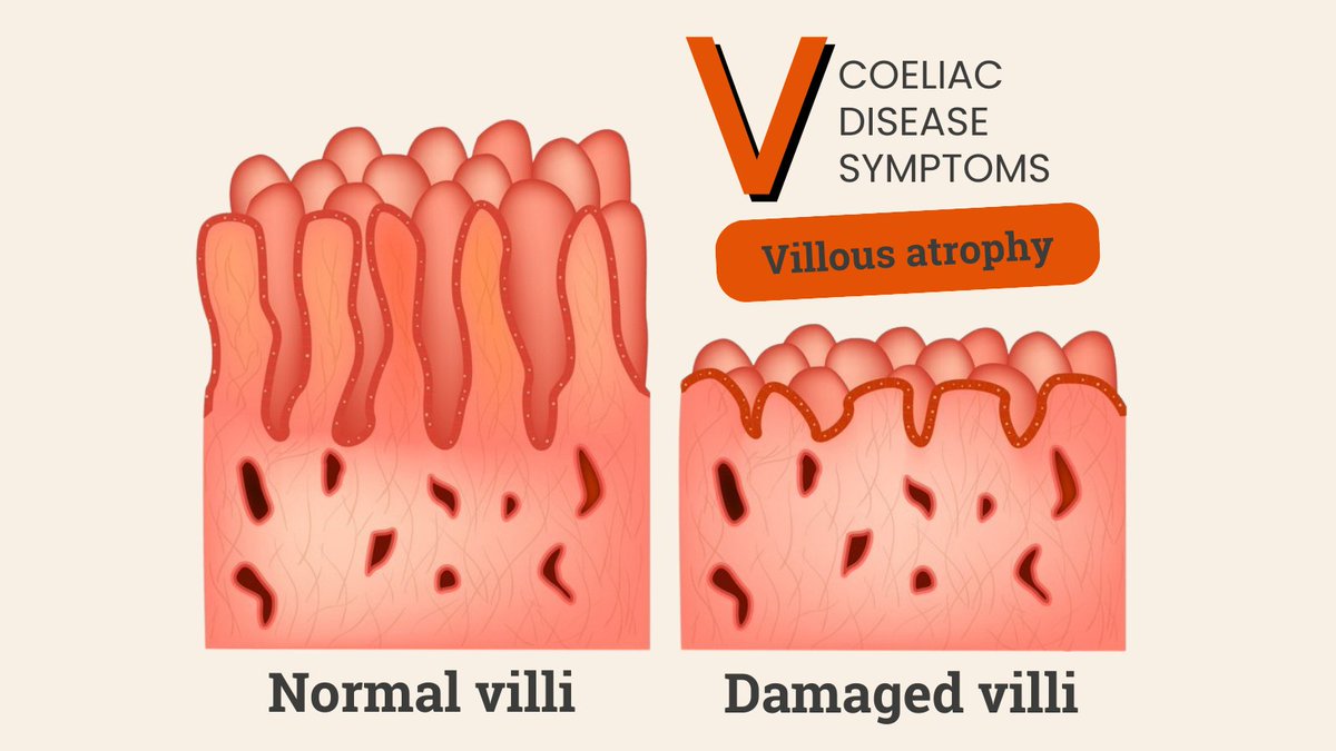 Coeliac_UK's tweet photo. A-Z of Coeliac Disease Symptoms: V is for Villous Atrophy  

In untreated coeliac disease, the villi in the small intestine become inflamed and flattened, leading to what's known as villous atrophy. This means the gut is unable to absorb nutrients properly, which can cause a range of complications over time. Villous atrophy can also be seen in other conditions, but in coeliac disease, it is triggered by gluten ingestion.  

Left untreated, villous atrophy can lead to malabsorption, causing deficiencies in essential nutrients like iron, calcium, and vitamins.  

When following a strict gluten free diet, the good news is that the villi can repair and function normally again.  

See the difference between healthy villi and damaged villi in coeliac disease above.  

Find out more about coeliac disease here: https://t.co/vG3SKOLWTc