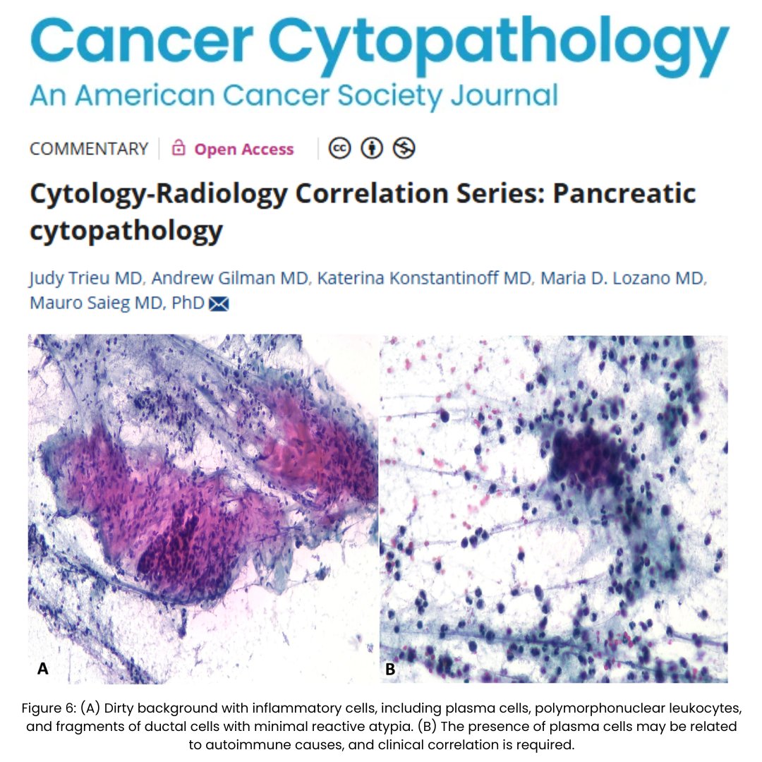 Cancer Cytopathology (@cancercytopath) on Twitter photo Announcing our Cyto-Rads Series! These papers explore corresponding radiologic imaging and cytology findings for commonly encountered entities. Our first edition is out today and deals with pancreatic #CytoPath!
acsjournals.onlinelibrary.wiley.com/doi/10.1002/cn…
<a href="/MauroSaieg/">Mauro Saieg, MD, PhD, FIAC</a> <a href="/mdlozanoe/">Lola Lozano</a> <a href="/TrieuMD/">Judy Trieu, MD, MPH</a> Announcing our Cyto-Rads Series! These papers explore corresponding radiologic imaging and cytology findings for commonly encountered entities. Our first edition is out today and deals with pancreatic #CytoPath!
acsjournals.onlinelibrary.wiley.com/doi/10.1002/cn…
<a href="/MauroSaieg/">Mauro Saieg, MD, PhD, FIAC</a> <a href="/mdlozanoe/">Lola Lozano</a> <a href="/TrieuMD/">Judy Trieu, MD, MPH</a>