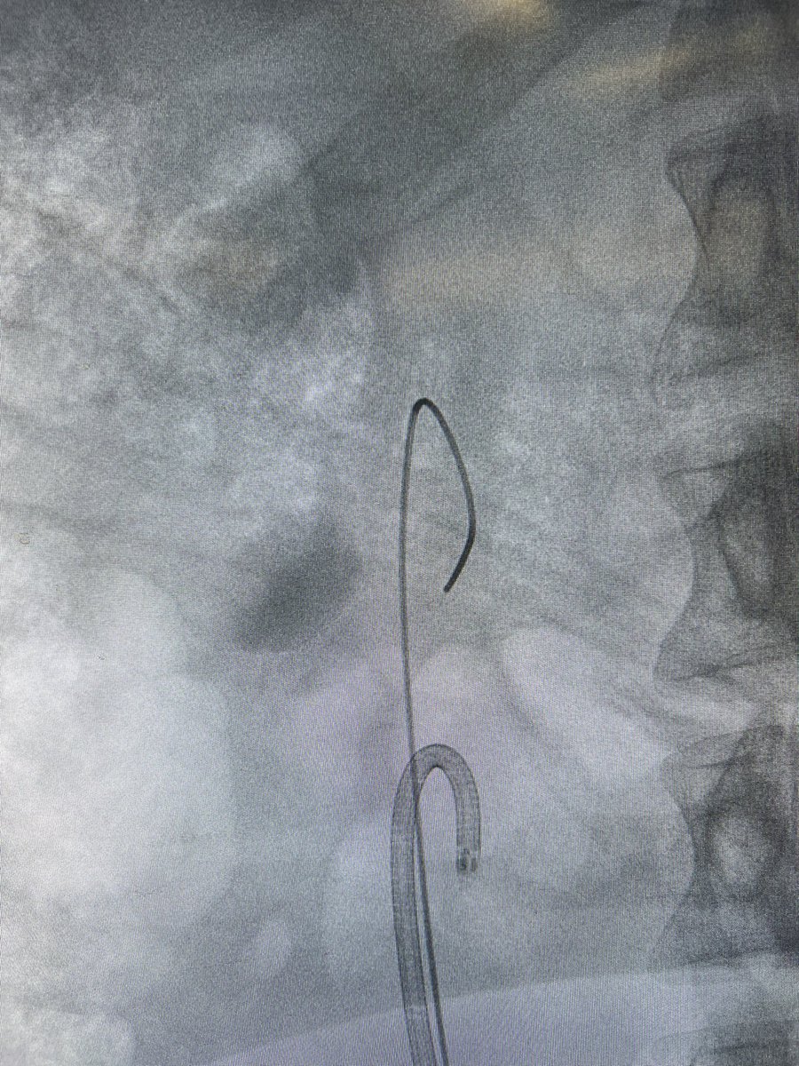 Dr. Wissam Kamal (@wissamabokhalid) on Twitter photo The beauty of Endourology. Sometimes with difficult anatomy even FANS couldn't be an option. DISS is perfect in such cases, a pelvic kidney treated with 7.5 Fr DISS from <a href="/PusenMedical/">Pusen Medical</a>, and another case of horsekiidney utilizing the 9 Fr with a larger worker channel The beauty of Endourology. Sometimes with difficult anatomy even FANS couldn't be an option. DISS is perfect in such cases, a pelvic kidney treated with 7.5 Fr DISS from <a href="/PusenMedical/">Pusen Medical</a>, and another case of horsekiidney utilizing the 9 Fr with a larger worker channel