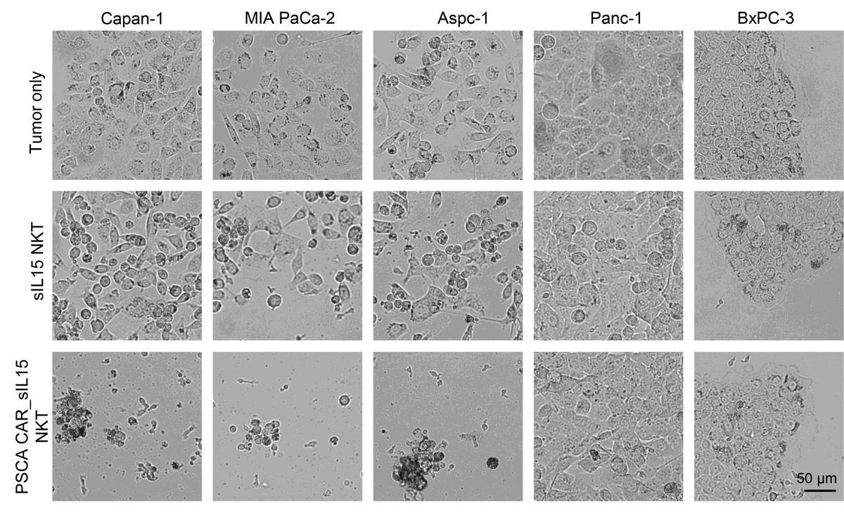 An off-the-shelf cell treatment that suppresses pancreatic cancer in mice!

Dai et al. show PSCA CAR_sIL15 NKT cells have anti-tumor activities without causing systemic toxicity or graft-versus-host disease in pancreatic ductal adenocarcinoma models: 
jci.org/articles/view/…