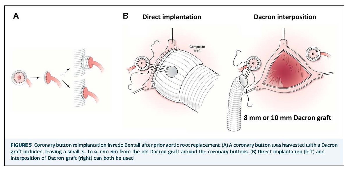 The Annals of Thoracic Surgery (@annalsthorsurg) on Twitter photo #EditorsChoice This expert review from <a href="/SuguruOhira/">Suguru Ohira, MD, PhD</a>, Spielvogel, and coauthors provides technical advice on scenarios where aortic root replacement may be challenging👇
doi.org/10.1016/j.atho… #EditorsChoice This expert review from <a href="/SuguruOhira/">Suguru Ohira, MD, PhD</a>, Spielvogel, and coauthors provides technical advice on scenarios where aortic root replacement may be challenging👇
doi.org/10.1016/j.atho…