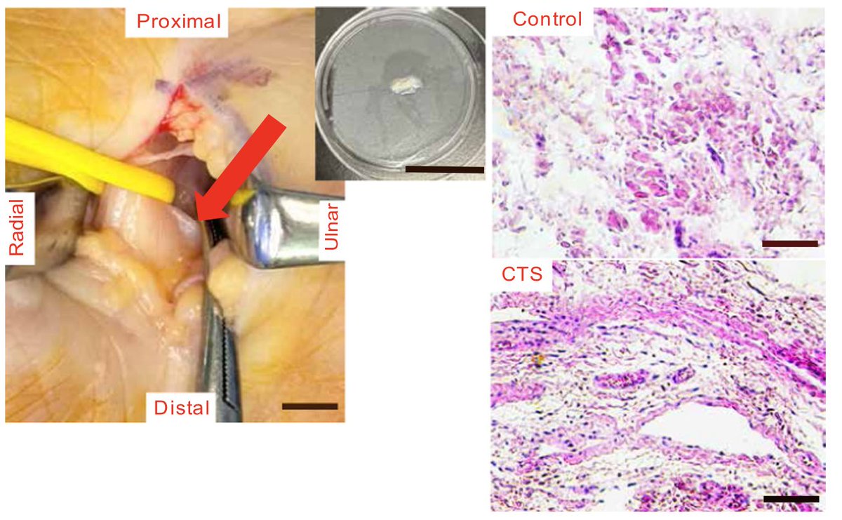 nesa_milan's tweet photo. The subsynovial connective tissue in carpal tunnel syndrome shows mitochondrial dysfunction, reduced ATP, elevated ROS, and altered ultrastructure.
New work  in @JOrthopRes sheds light on the cellular basis of CTS symptoms. #ORSSML @ORSsociety 
link: https://t.co/l2VY11DXJz https://t.co/aELNljtkLP