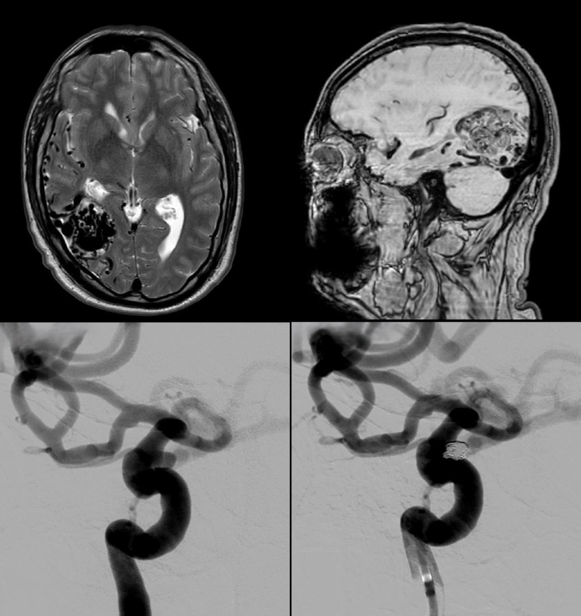 CarlosC74716941's tweet image. Cerebral arteriovenous malformation (#AVM) + ICA #Aneurysm
Treatment: 
- Aneurysm: Balloon-assist #Coiling.
- AVM: #Embolization + #Surgery.
Complete aneurysm and AVM exclusion.
Thanks:
Dr. Carlos Domínguez (NSG).
Dr. Alicia Martínez (Neurophisiol).
Rosa García-Sort (INR Nurse).