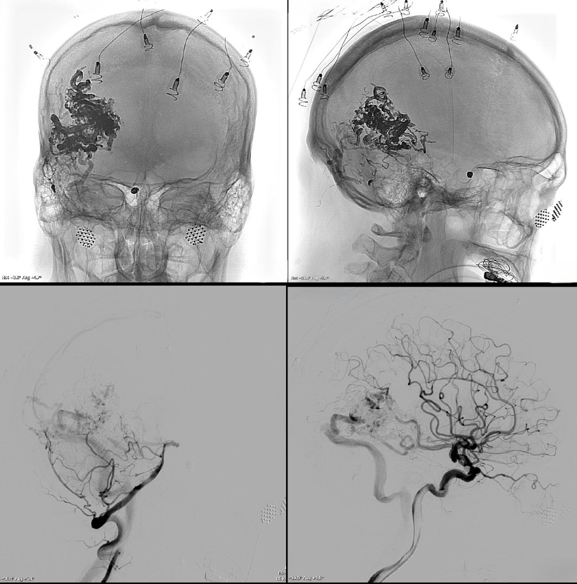 CarlosC74716941's tweet image. Cerebral arteriovenous malformation (#AVM) + ICA #Aneurysm
Treatment: 
- Aneurysm: Balloon-assist #Coiling.
- AVM: #Embolization + #Surgery.
Complete aneurysm and AVM exclusion.
Thanks:
Dr. Carlos Domínguez (NSG).
Dr. Alicia Martínez (Neurophisiol).
Rosa García-Sort (INR Nurse).