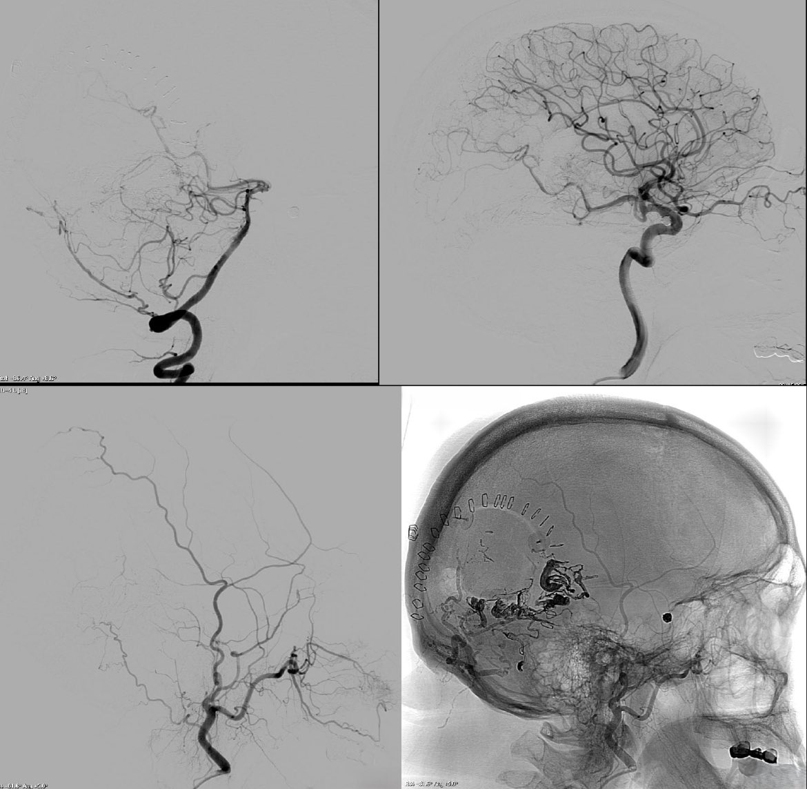 CarlosC74716941's tweet image. Cerebral arteriovenous malformation (#AVM) + ICA #Aneurysm
Treatment: 
- Aneurysm: Balloon-assist #Coiling.
- AVM: #Embolization + #Surgery.
Complete aneurysm and AVM exclusion.
Thanks:
Dr. Carlos Domínguez (NSG).
Dr. Alicia Martínez (Neurophisiol).
Rosa García-Sort (INR Nurse).