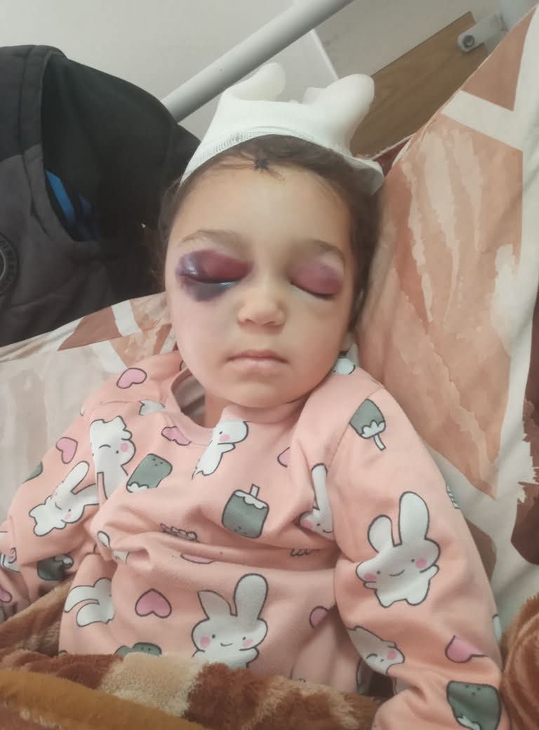 Bu çocuk benim akrabam.. Terörist  İsrail onun gözlerini yaktı..!

Şerefsizler