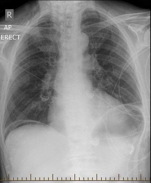 A 65 year old man is recovering the day after a laparoscopic bowel resection.

You examine him and find crackles in his right mid and lower lung field, and order an X-ray to investigate.

What does it show?

oslercommunity.com/s/preview/quiz…

#meded #medtwitter #FOAMed #CPDHomes #CPDHome
