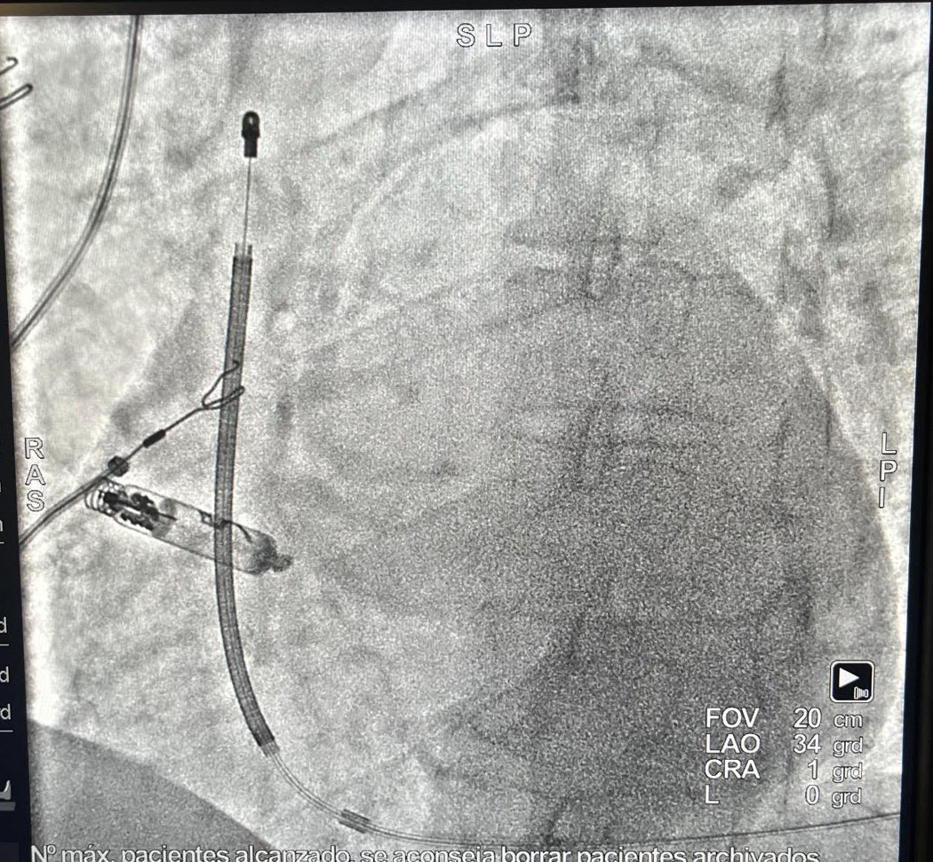 Our first AR Aveir leadless pacemaker. Keep moving on!