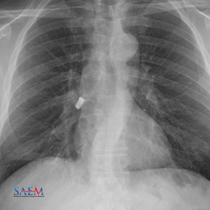 SAEM Clinical Images Series: I'm Plugged Up

Where is this sitting? How can we get it out?

aliem.com/saem-clinical-…

<a href="/SAEMonline/">SAEM</a>