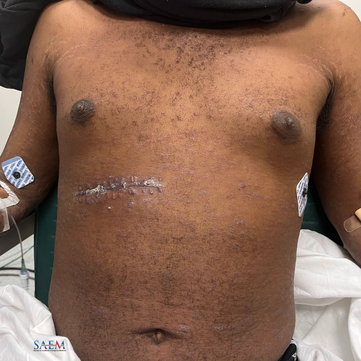 SAEM Clinical Images Series: I Cannot See My Rashes

How might the diffuse rash in this picture and bilateral painful vision loss be related?

aliem.com/saem-clinical-…

<a href="/SAEMonline/">SAEM</a>