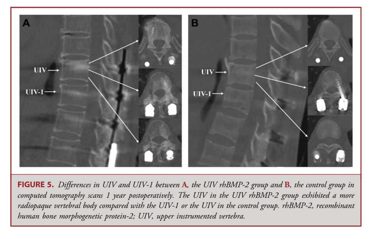 John H. Shin MD, MBA (@johnhshinmd) on Twitter photo Check this out from the latest <a href="/NeurosurgeryCNS/">Neurosurgery Publications</a>: The Effect of Transpedicular Injection of rhBMP-2 on Prevention of Proximal Junctional Kyphosis.
<a href="/CNS_Update/">CNS</a> <a href="/DKondziolkaCNS/">Douglas Kondziolka</a>
journals.lww.com/neurosurgery/a… Check this out from the latest <a href="/NeurosurgeryCNS/">Neurosurgery Publications</a>: The Effect of Transpedicular Injection of rhBMP-2 on Prevention of Proximal Junctional Kyphosis.
<a href="/CNS_Update/">CNS</a> <a href="/DKondziolkaCNS/">Douglas Kondziolka</a>
journals.lww.com/neurosurgery/a…