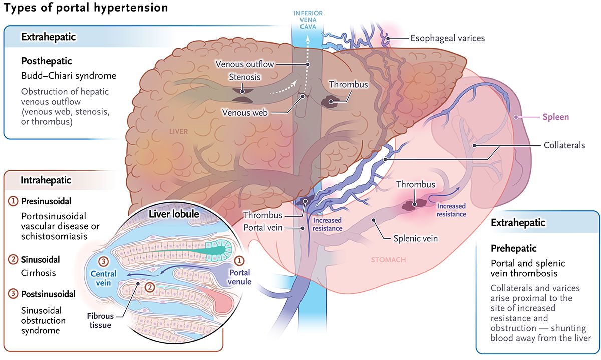 Tipos de hipertensión portal. NEJM. 2023 Liver Transplantation for Mahvash Disease, an Inborn Error of Metabolism DOI: 10.1056/NEJMe2310332