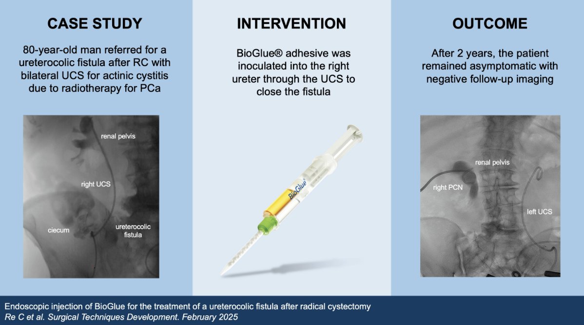 SurgicalTD_MDPI's tweet photo. #mdpiSTD Our newest article, "Endoscopic Injection of BioGlue for the Treatment of a Ureterocolic Fistula After Radical Cystectomy" by Chiara Re et al., has just been published.
https://t.co/KfJJY8gvm5
@MDPIOpenAccess @Scilit_ @MediPharma_MDPI
#urology #surgery #BioGlue https://t.co/xV7bqTRnGU